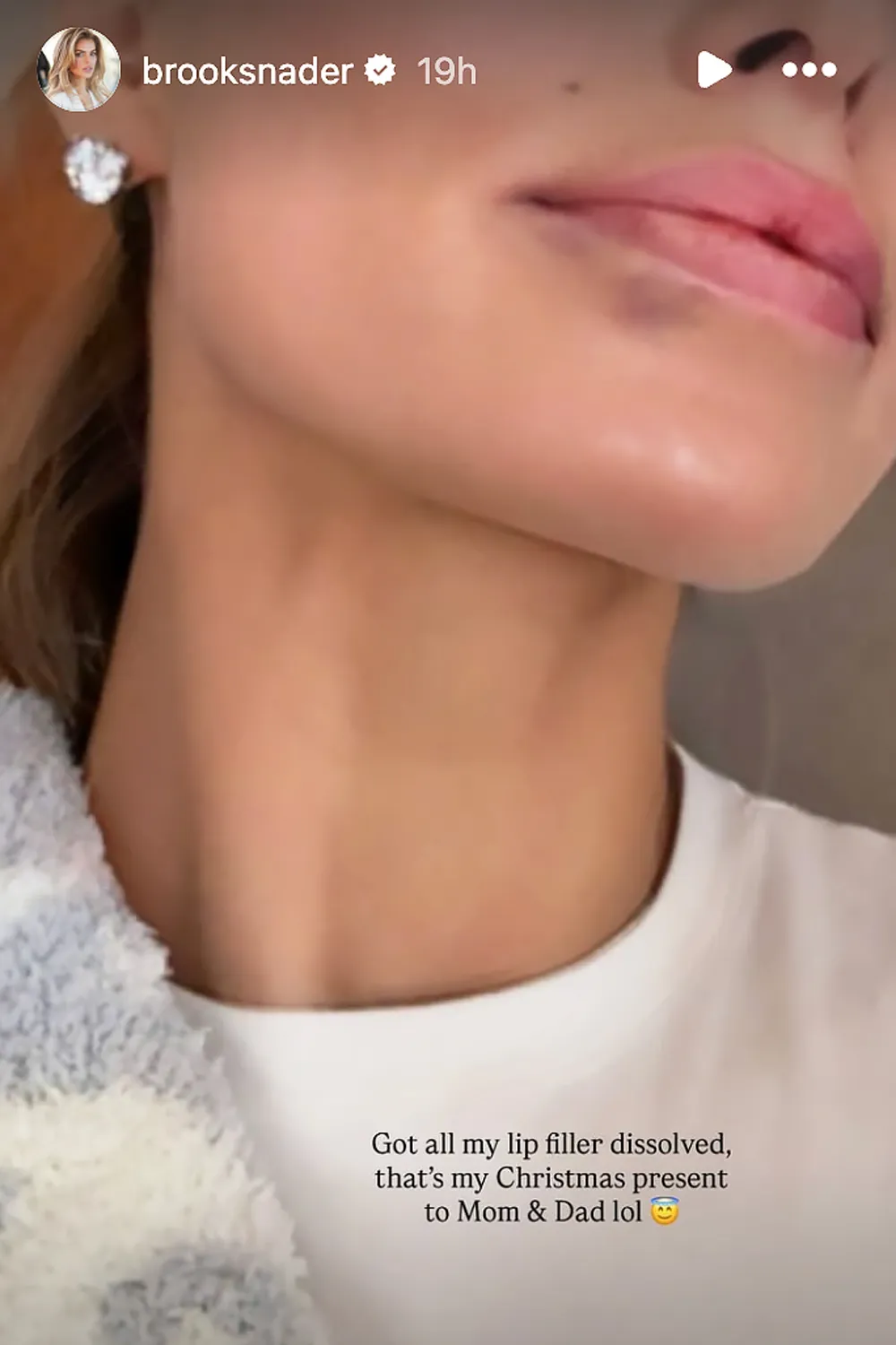 Brooks Nader Dissolves Lip Filler as a Gift to Her Parents.