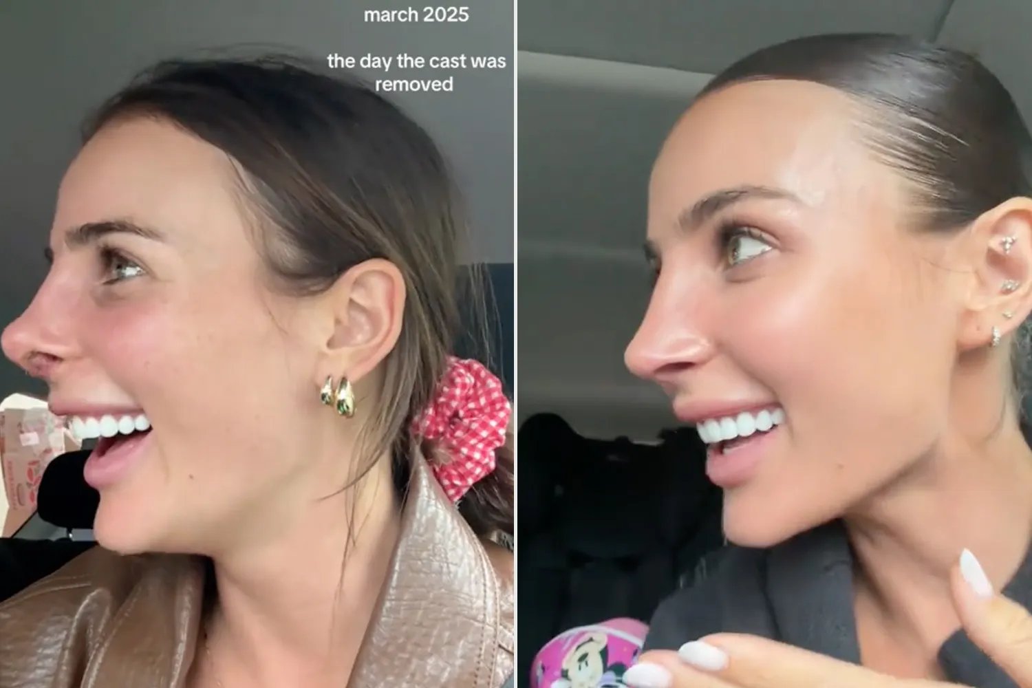 Indy Clinton shows off results of second nose job.