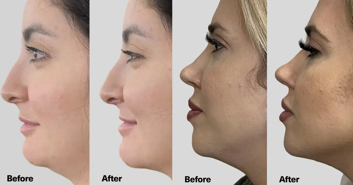 Say Goodbye to Botox and Fillers: How This Jaw Defining Serum Can Help You Look Younger