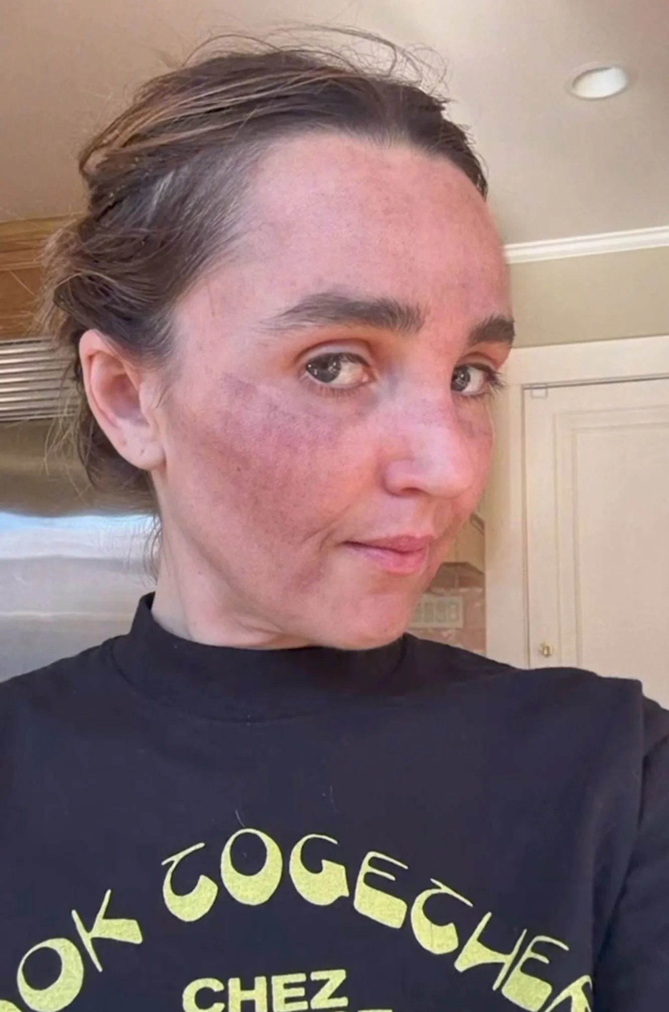 Chloe Fineman Shares 'Botched' iPhone Photos of Cosmetic Procedures