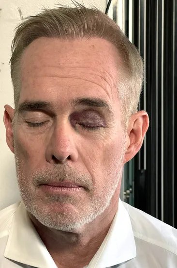 Joe Buck Reveals He Had a Concealed Black Eye During ESPN Broadcast After ‘Breaking Up a Fight’ Between His Twin Sons