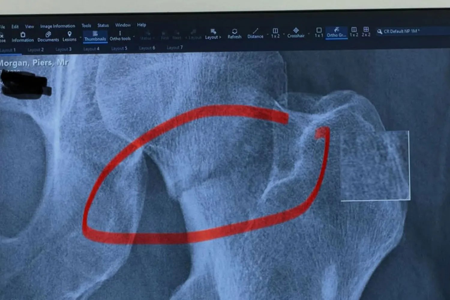 Piers Morgan Hospitalized