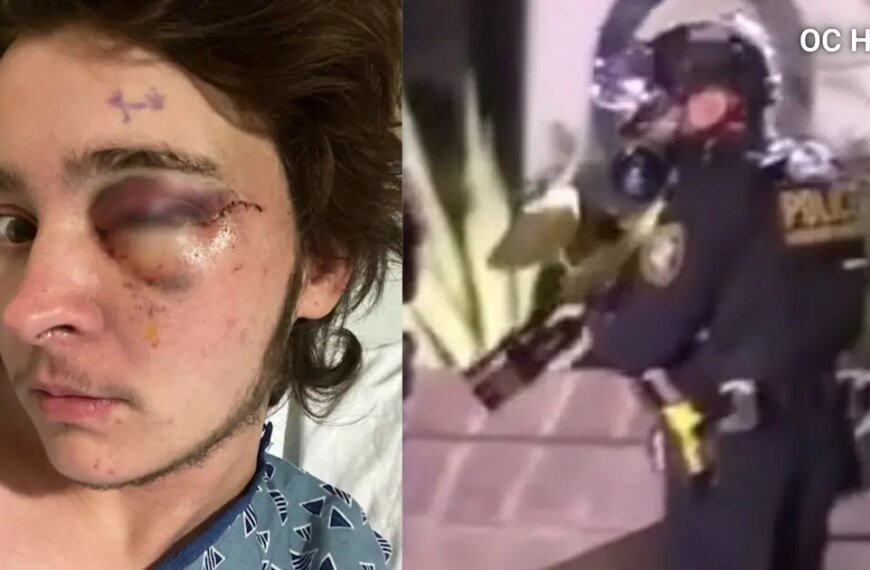 Protester Says He's Lost His Sight After Being Shot by Federal Officer in Santa Ana