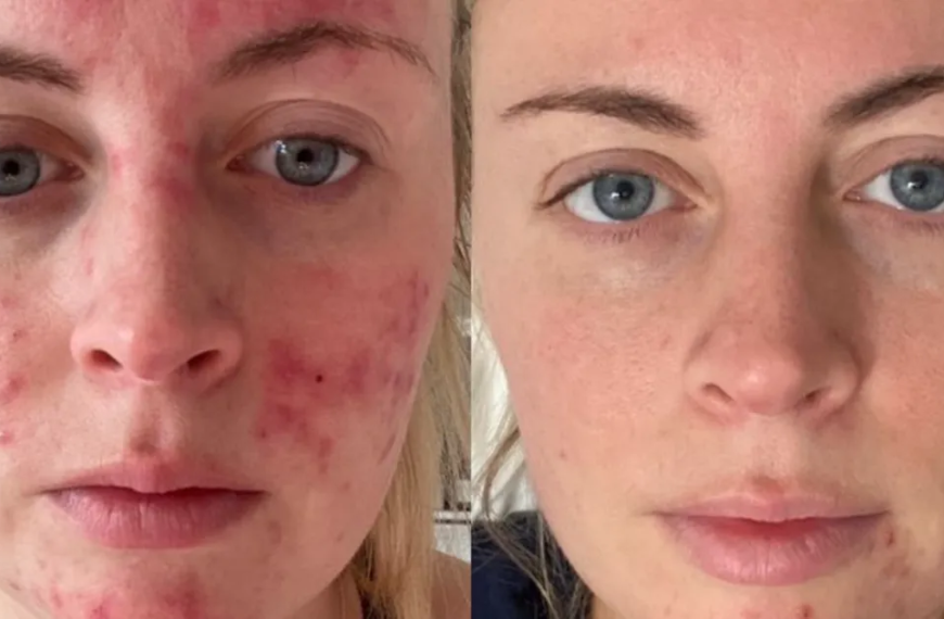 Say Goodbye to Blemishes and Scars with This Easy Repair Serum