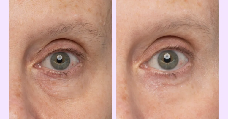 Say Goodbye to Under Eye Bags: This Affordable Eye Gel Works Wonders in Just 5 Minutes