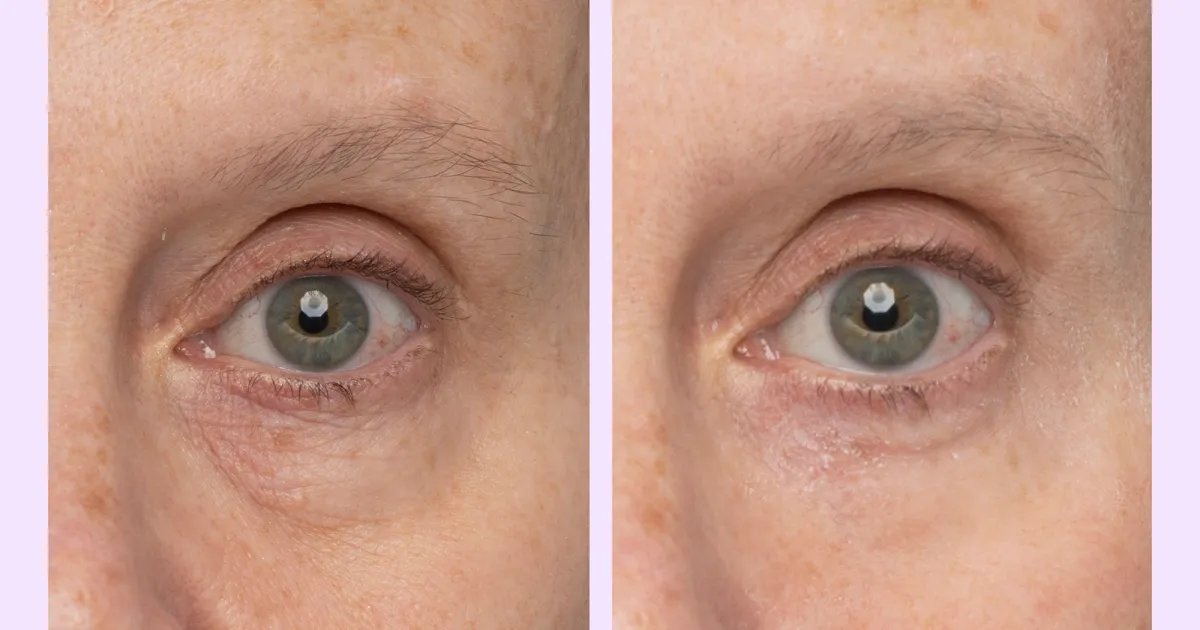 Say Goodbye to Under Eye Bags: This Affordable Eye Gel Works Wonders in Just 5 Minutes