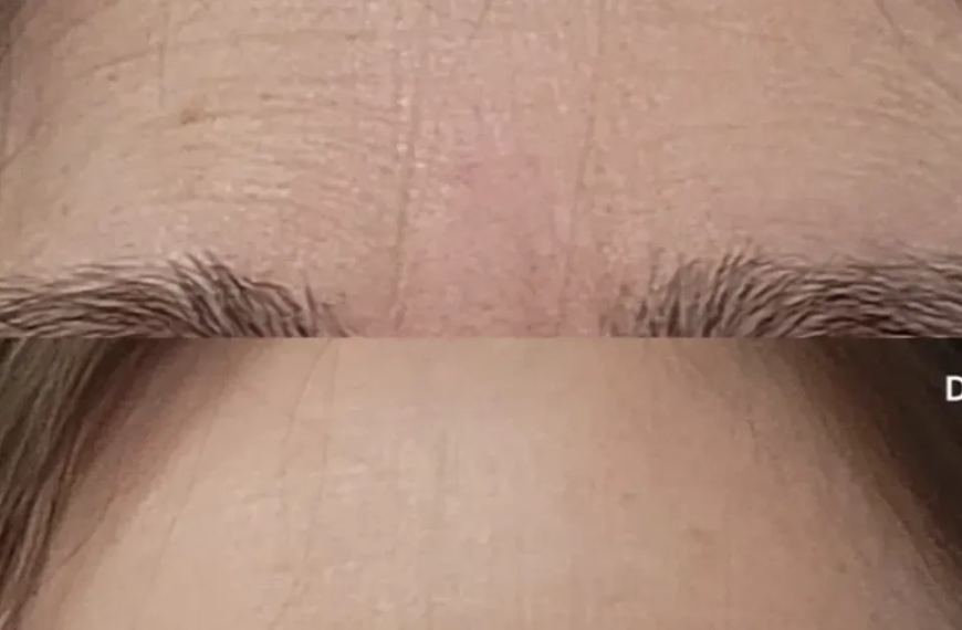 Wave Goodbye to Brow Wrinkles: A Simple 3-Minute Treatment for a Youthful Look