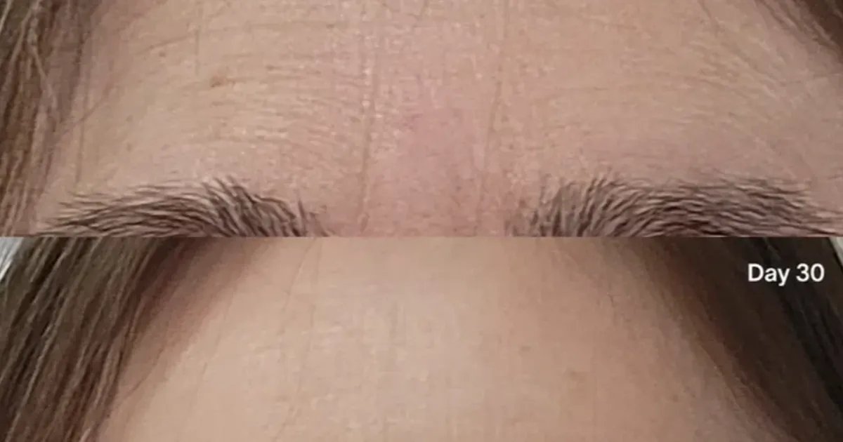 Wave Goodbye to Brow Wrinkles: A Simple 3-Minute Treatment for a Youthful Look