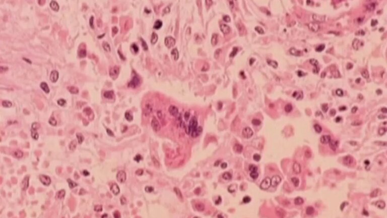 LA County Reports Fifth Case of Measles This Year